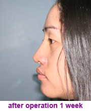 plastic_surgery_augmentation_rhinoplasty